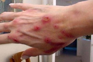 National Center for Disease Control warns leishmaniasis cases are on the rise